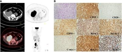 Case Report: CD19 CAR T-cell therapy following autologous stem cell transplantation: a successful treatment for R/R CD20-negative transformed follicular lymphoma with TP53 mutation